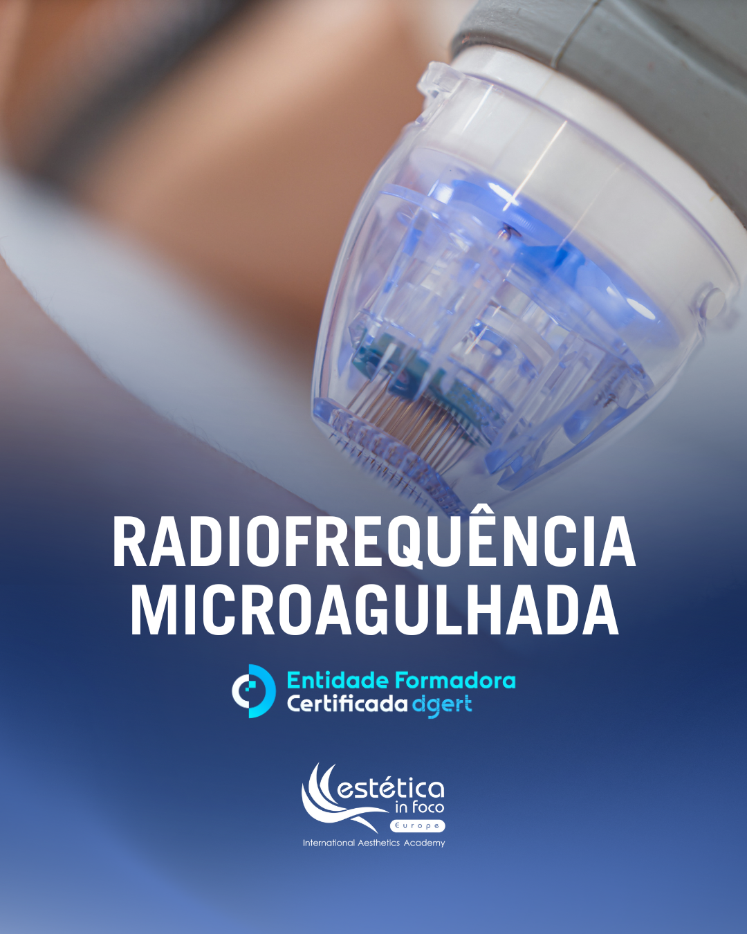 19 Fevereiro | Porto - Radiofrequência Microagulhada